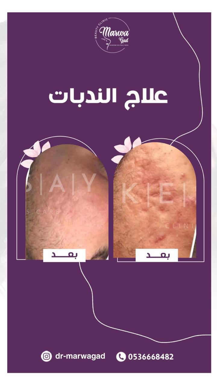 علاج ندبات